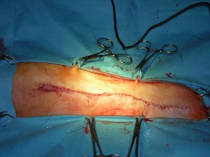 infezioni di ferite cutanee post-chirurgiche