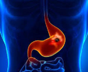 lesioni nella mucosa del piccolo intestino